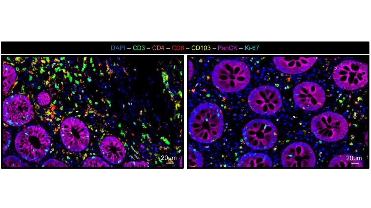 Darmgewebes eines Patienten mit starken Entzündungen im Darm vor (links) und nach der Therapie. Die Immunzellen sind in der Immunfluoreszenz-Färbung grün, orange, rot und gelb.